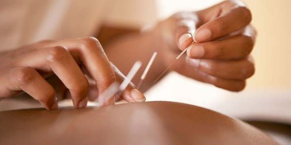 alternative medicine acupuncture