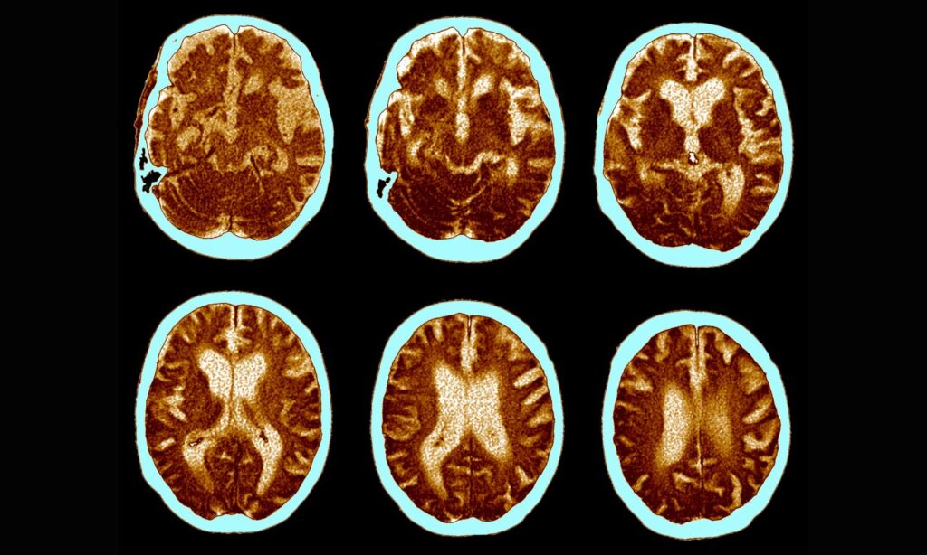 An image showing brains with Alzheimer's disease to illustrate an article on Alzheimer's breakthroughs