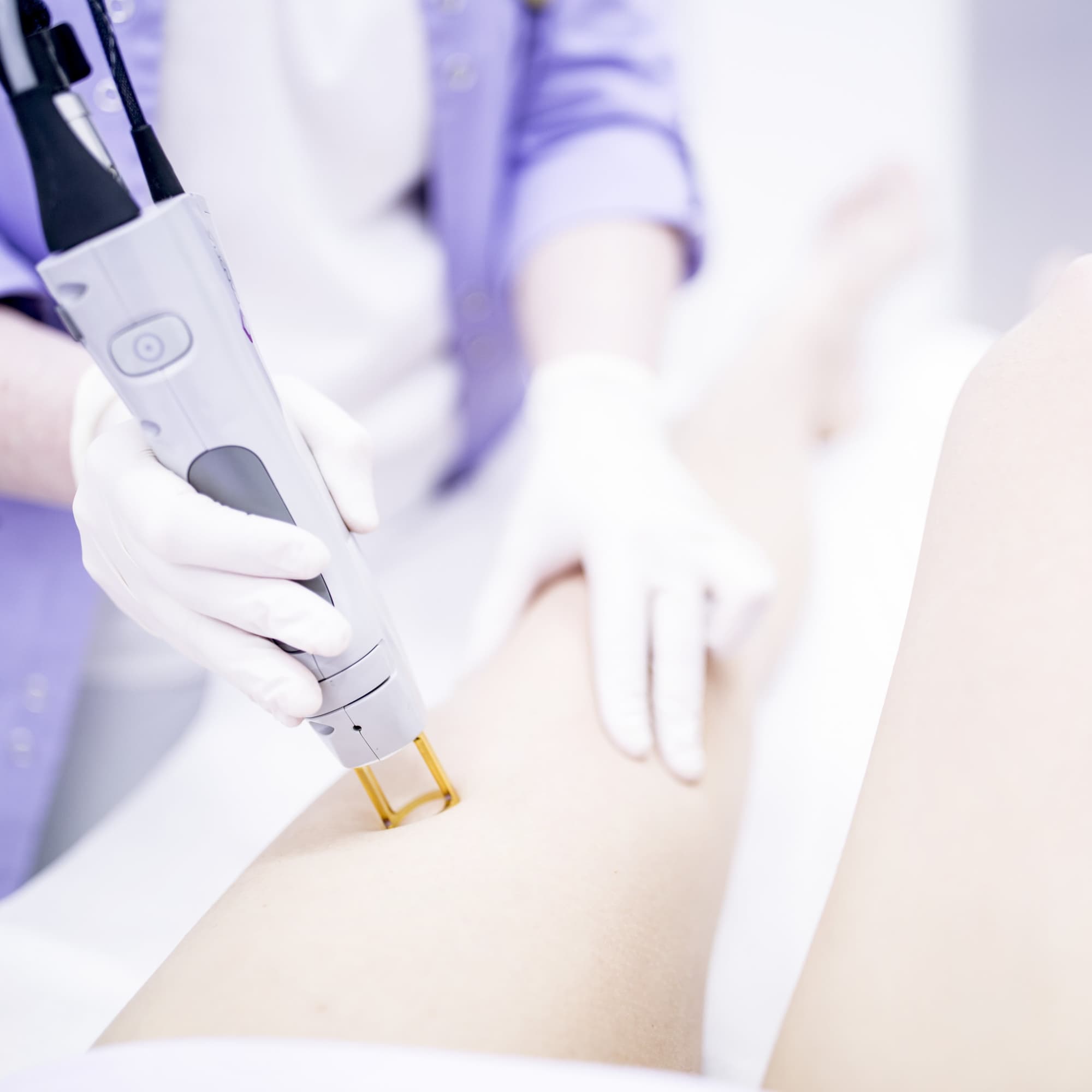 an-expert-explains-what-happens-when-you-miss-your-laser-hair-removal